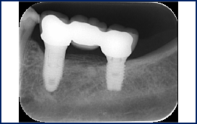Basic Implant