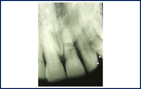 Imediate Implants